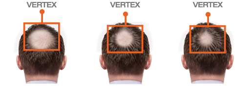 FOLIGAIN Men's Hair Regrowth Kit