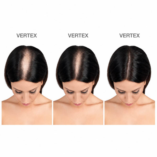 FOLIGAIN® Women's Hair Regrowth Kit with TRIOXIDIL® 10% and Minoxidil 2%