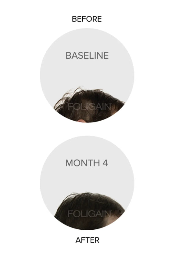 FOLIGAIN Triple Action Complete Formula For Thinning Hair For Women with 10% Trioxidil - FOLIGAIN