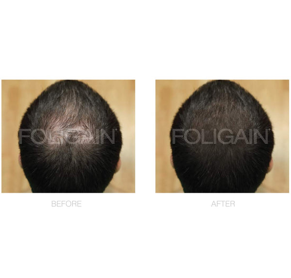 FOLIGAIN Low Alcohol Minoxidil 5% Hair Regrowth Treatment For Men 12 Month Supply